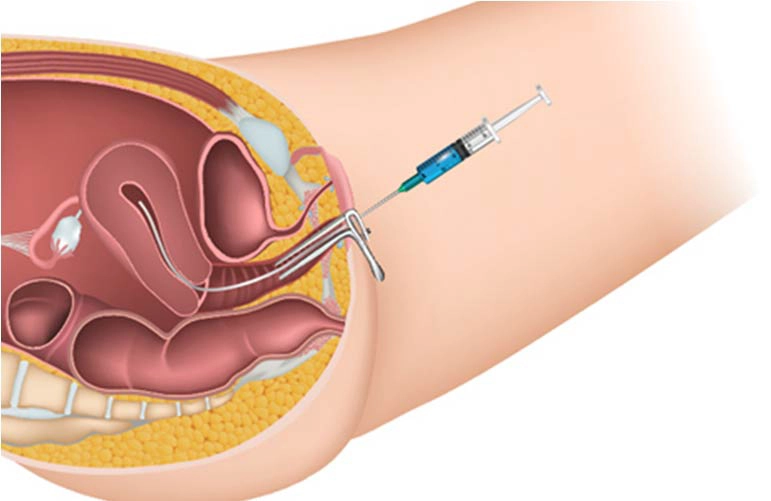 Intrauterine Insemination (IUI)
