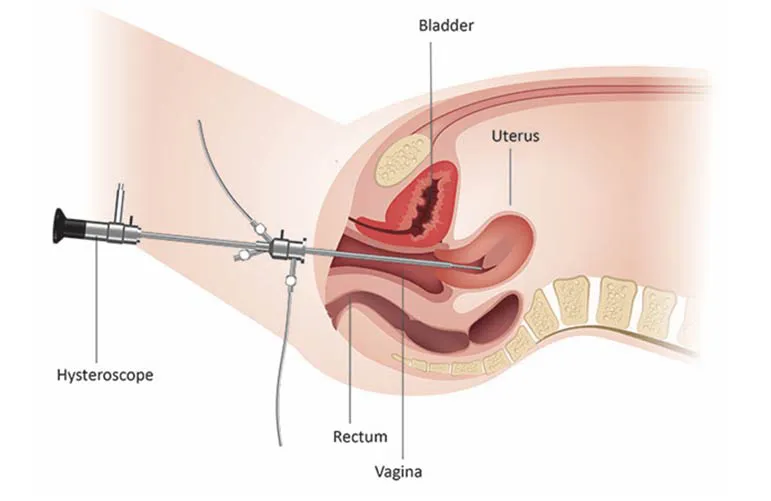 Diagnostic Hysteroscopy