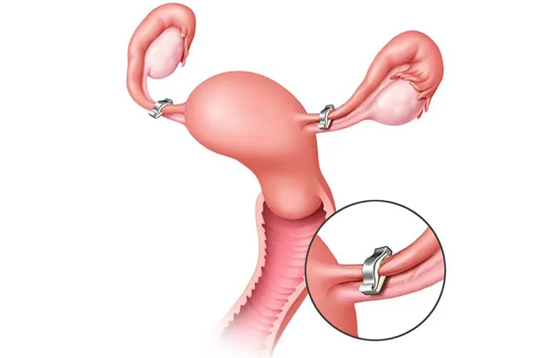 Ovarian And Tubal Surgery