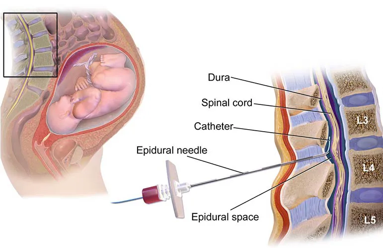 Painless Vaginal Delivery (Epidural)